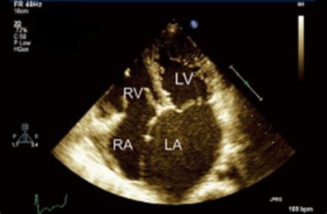 hypokinesis of left ventricle